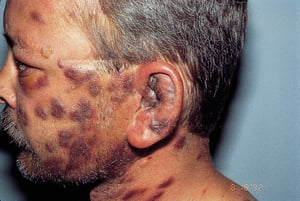 Kaposi Sarcoma (Face)