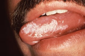 Oral Hairy Leukoplakia