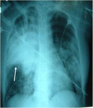 Severe Pneumonia